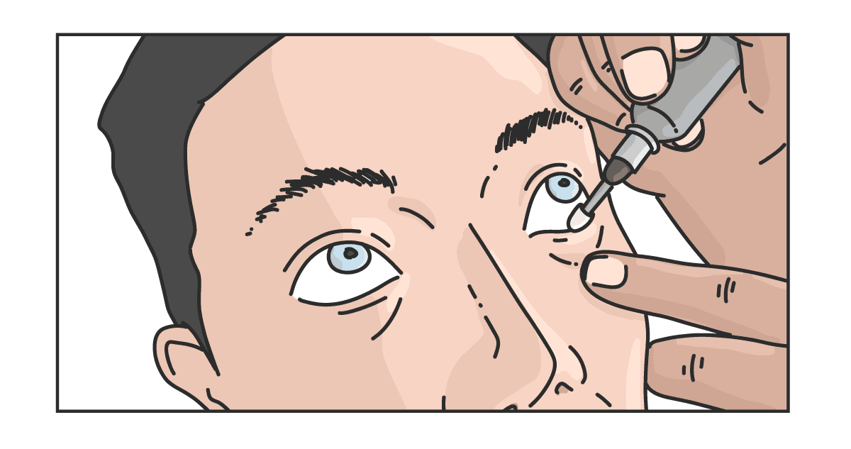 Microblepharoexfoliation