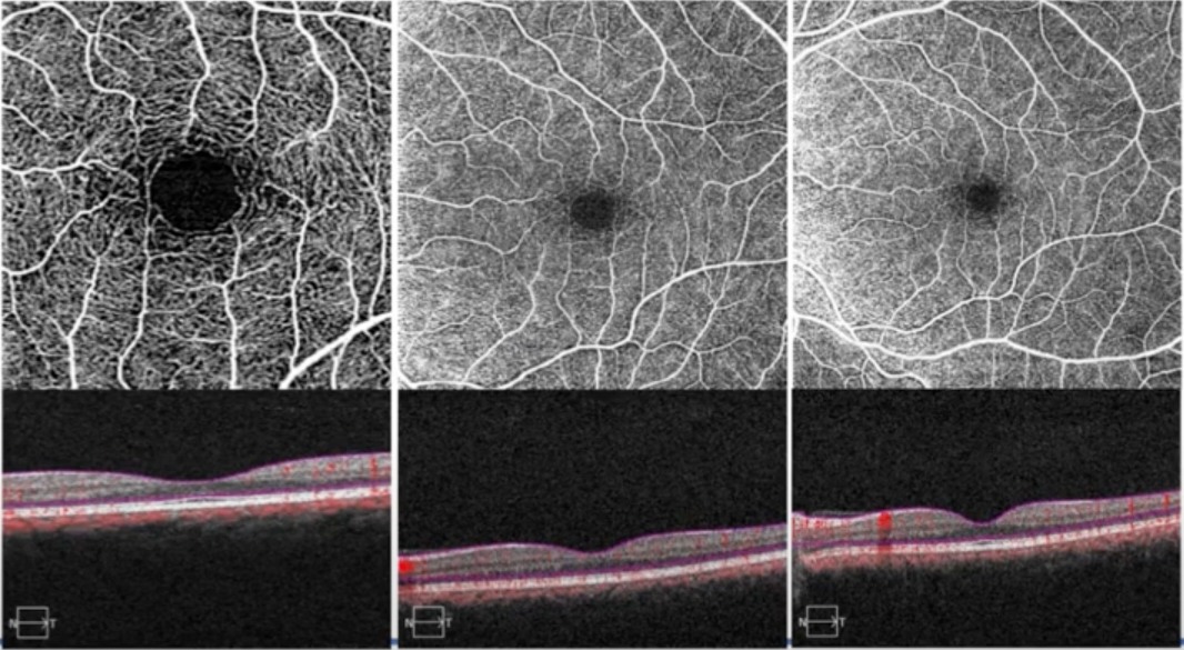 OCTA retinal vasculature slab view