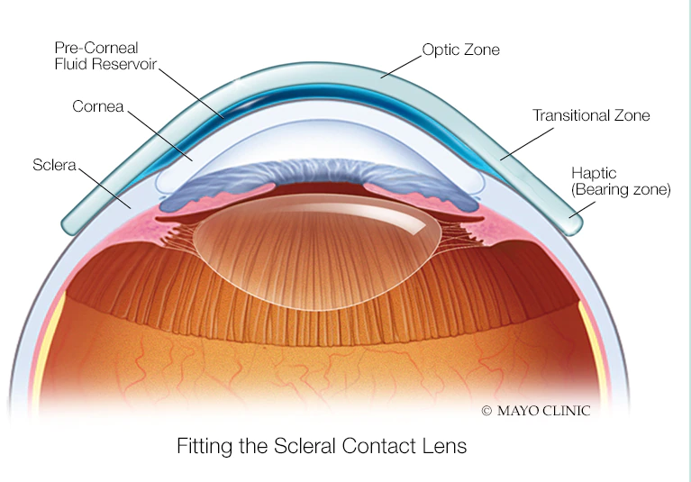 Fitting the Scleral Contact Lens
