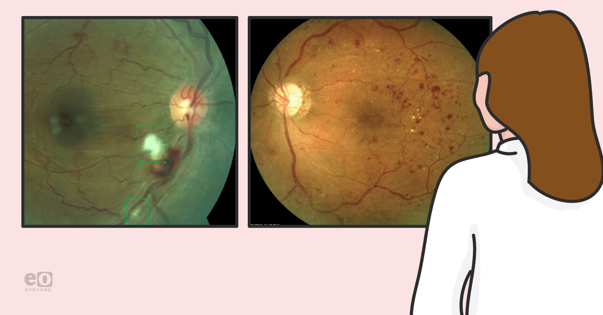 A Resident's Guide to Diabetic Retinopathy Surgical Treatment Options