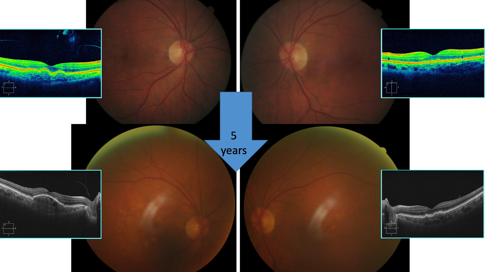 Dry AMD with drusenoid PED fundus image 5 Year PED