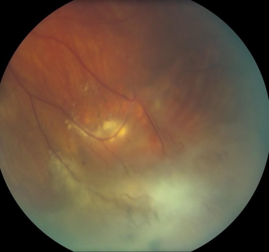 Figure 5: Presentation of intermediate uveitis with peripheral periphlebitis in a patient with multiple sclerosis.
