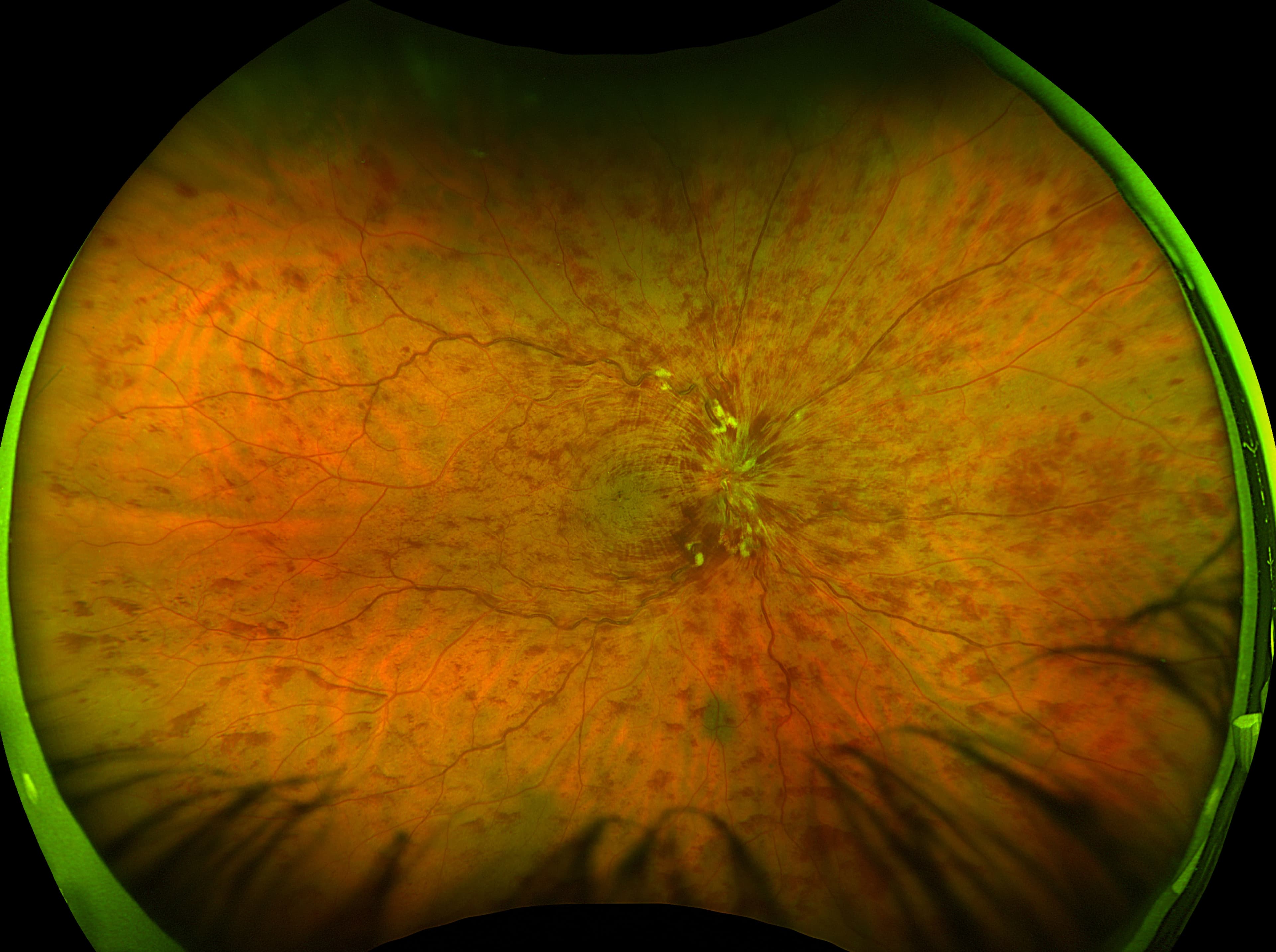 Retinal C The OD's Guide to Retinal Vein Occlusion with Cheat Sheet