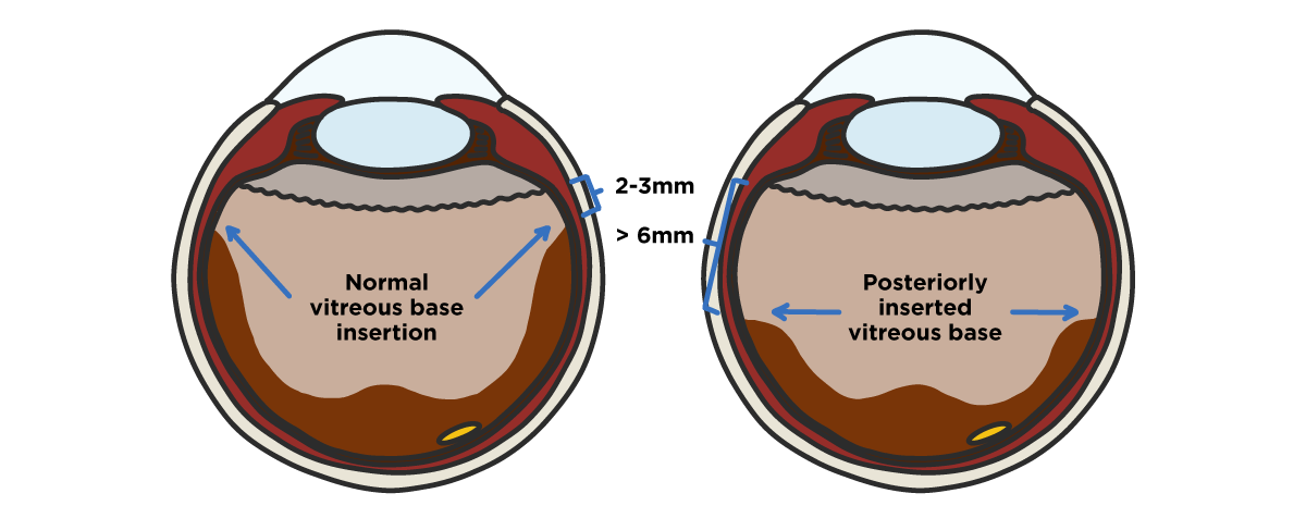 Retinal detachment vitreous base