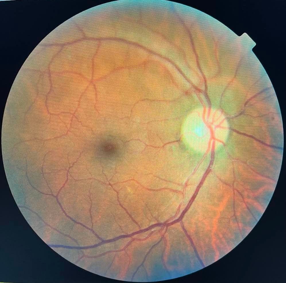 Non-proliferative diabetic retinopathy Fundus OD