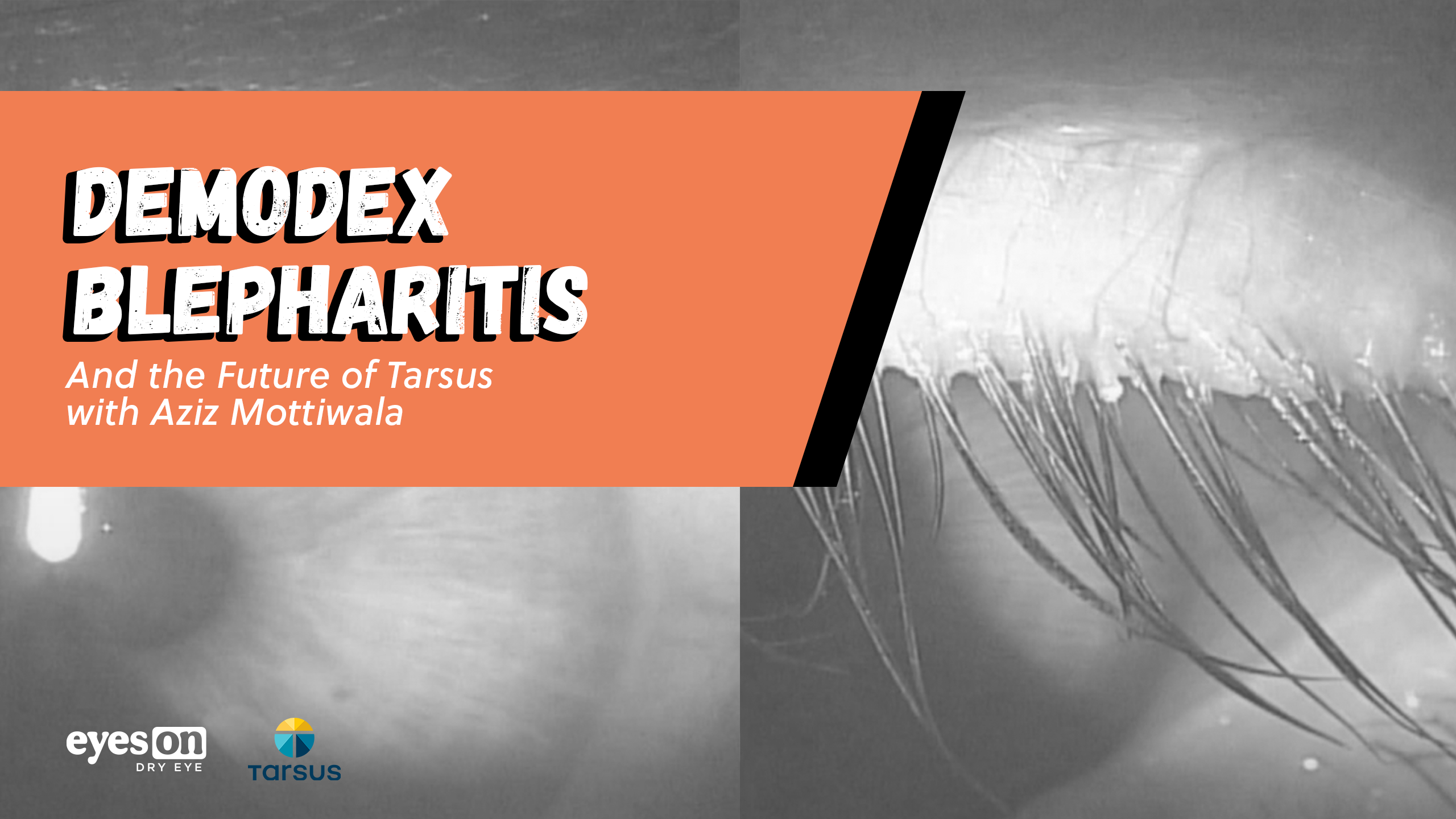 Slit Lamp Exams and Collarettes: The High Prevalence of Demodex Blepharitis and What Tarsus is Aiming to Do About It