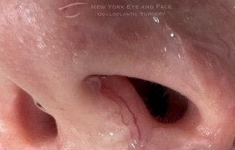 Image of a patient's nose with facial vessels before undergoing BBL therapy.
