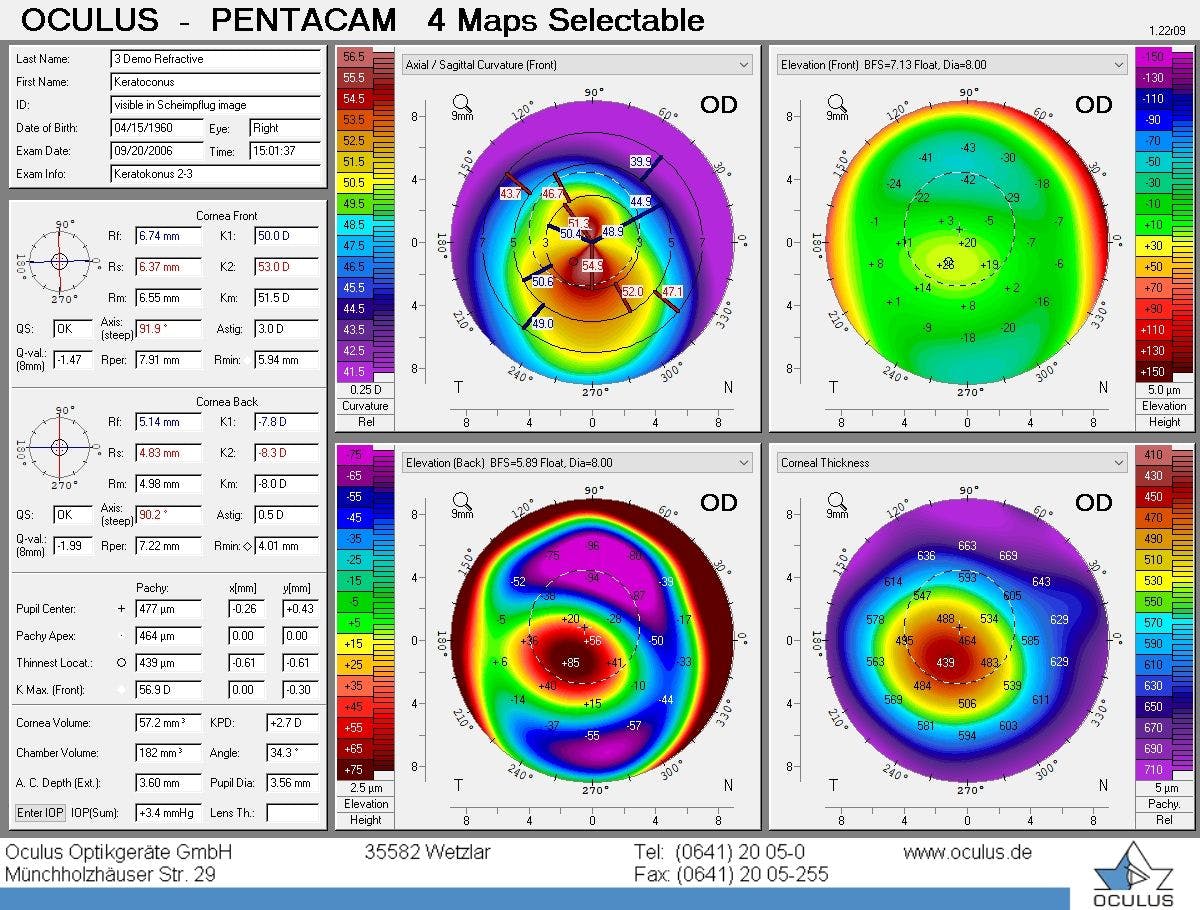 Scheimpflug imaging with keratoconus exhibiting significant steepening on the anterior curvature map