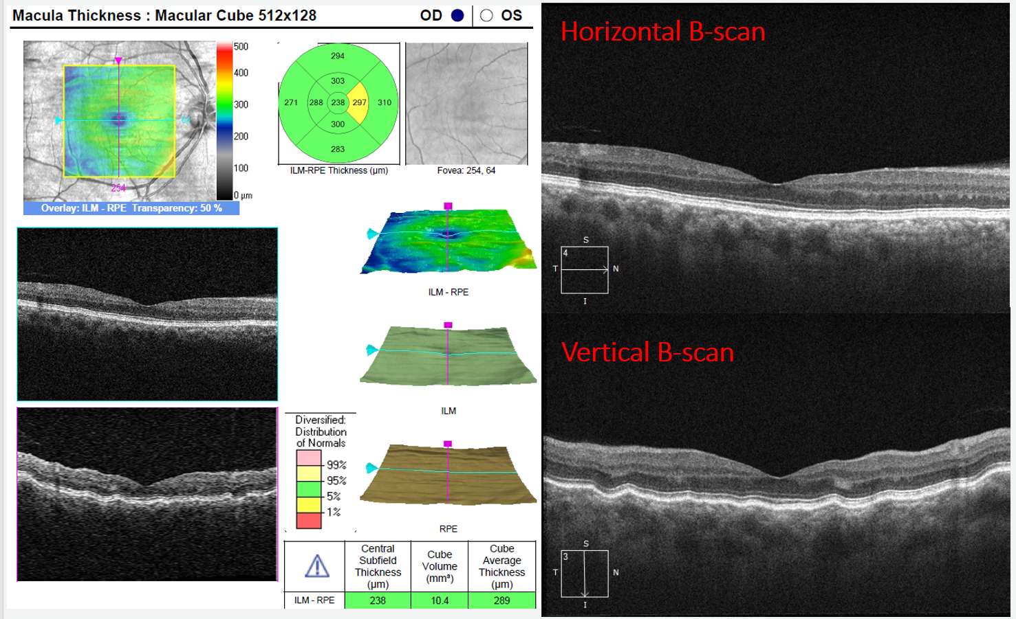 In this case of choroidal folds minimal RPE disruption is seen on the horizontal scan while the vertical scan makes the choroidal and retinal effects apparent
