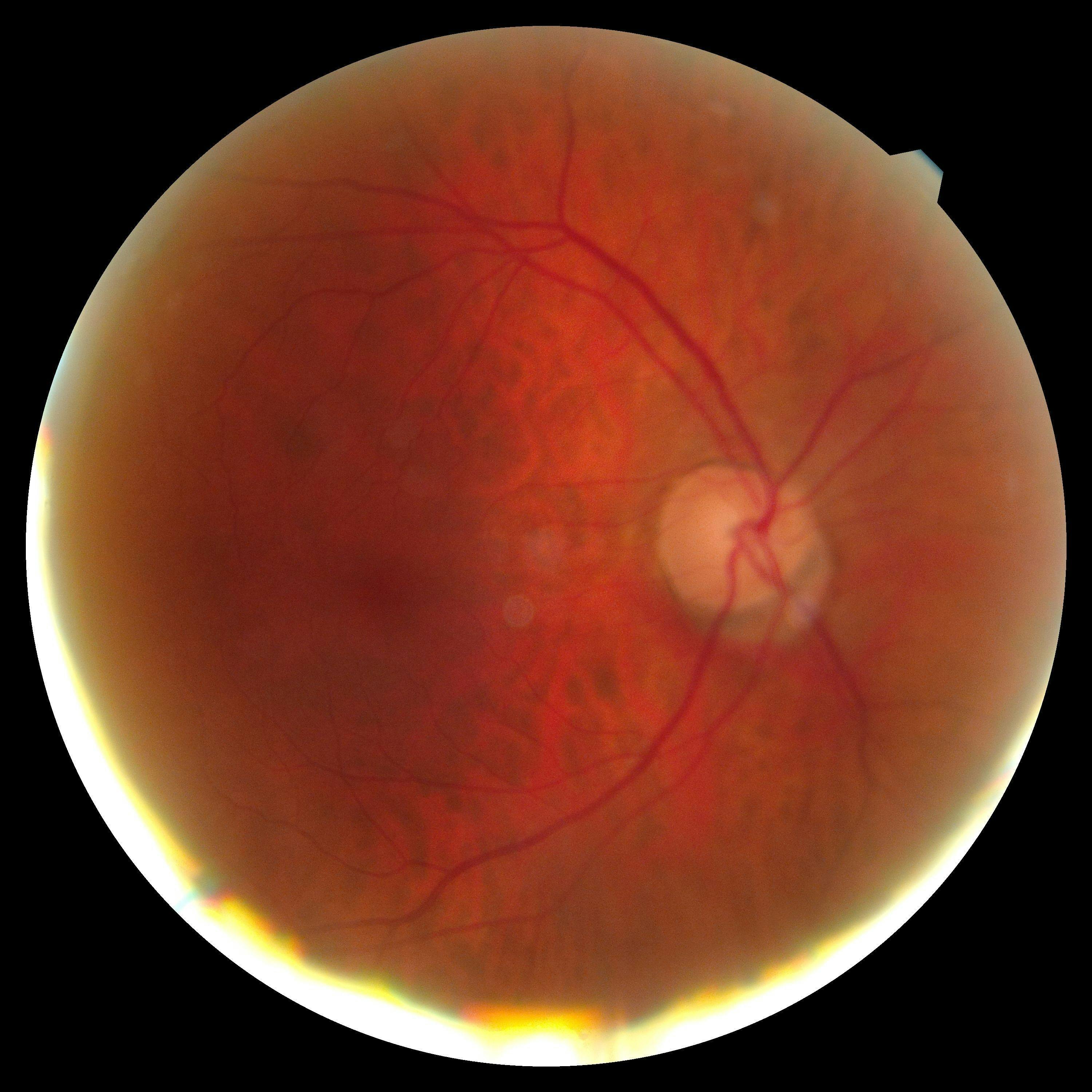 OD fundus initial NAION