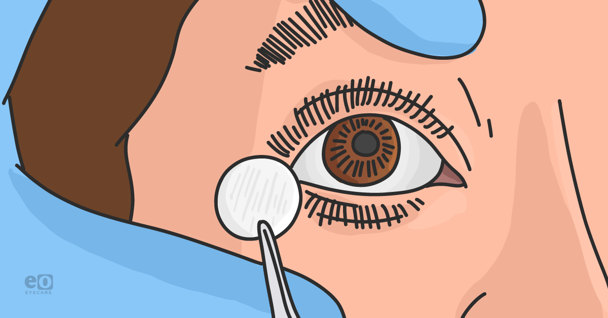 How to Use Amniotic Membranes in Dry Eye Treatment