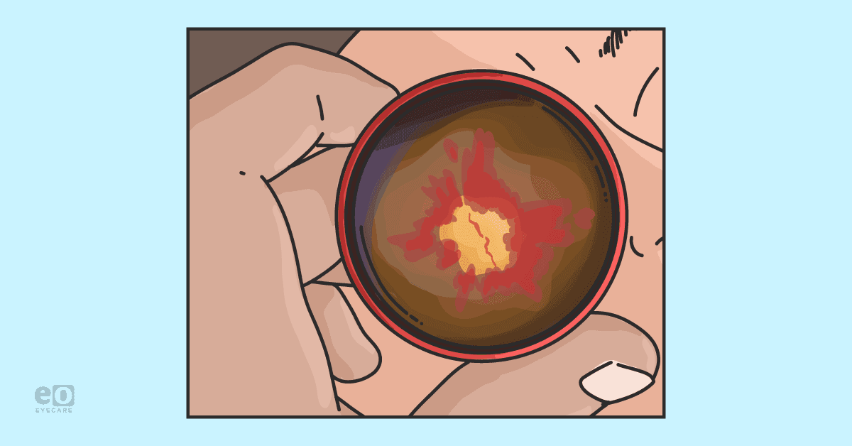 Image of an optometrist performing a fundus examination on a patient that shows diabetic papillopathy.