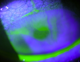 Limbal Stem Cell Deficiency Staining