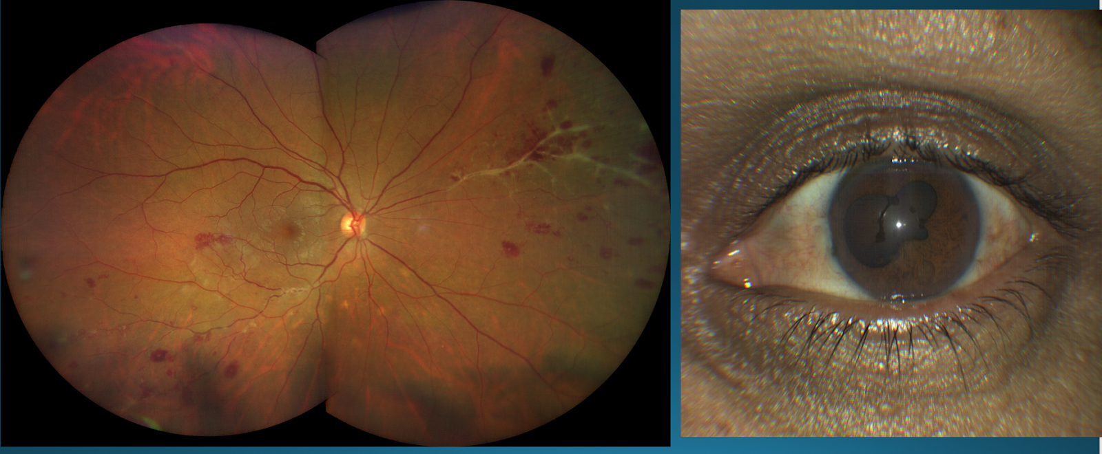 Figure 5: The Zeiss CLARUS 500 imaging a patient with retinal vasculitis (left) with anterior segment involvement. Anterior segment camera shows an image of iris synechiae (right).
