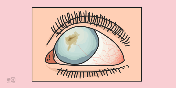 How to Treat Corneal Scarring: A Resident's Guide