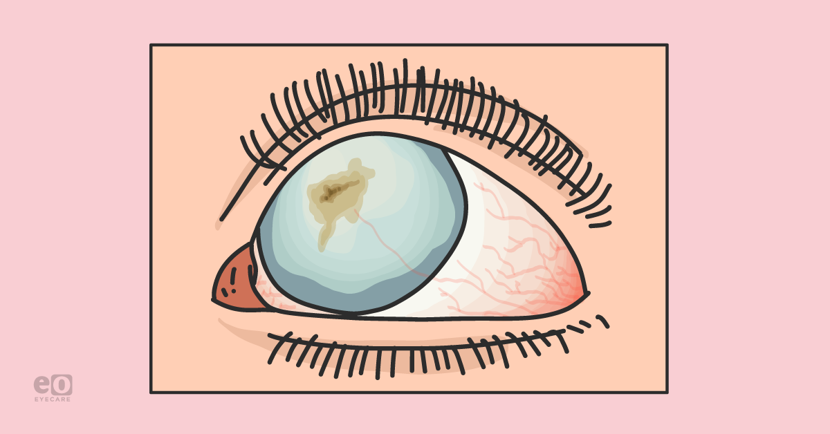 How to Treat Corneal Scarring: A Resident's Guide