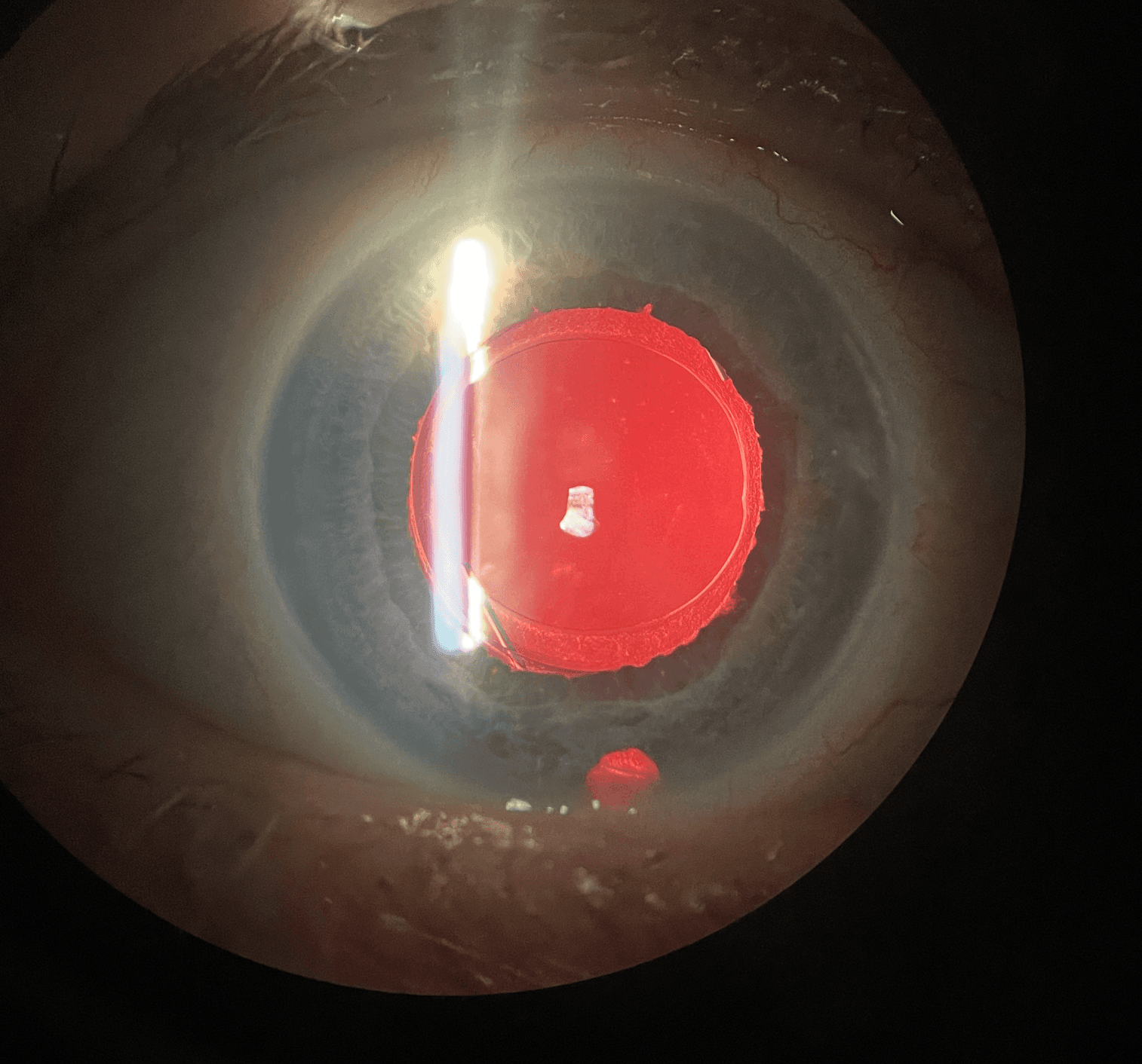 Refractive Cataract Surgery In Fuchs Endothelial Corneal Dystrophy refractive-cataract-surgery-in-fuchs-endothelial-corneal-dystrophy