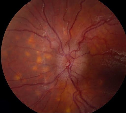 Figure 9: Presentation of posterior uveitis (disc edema focal retinitis) secondary to infection with the spirochete Borrelia burgdorferi in Lyme disease.