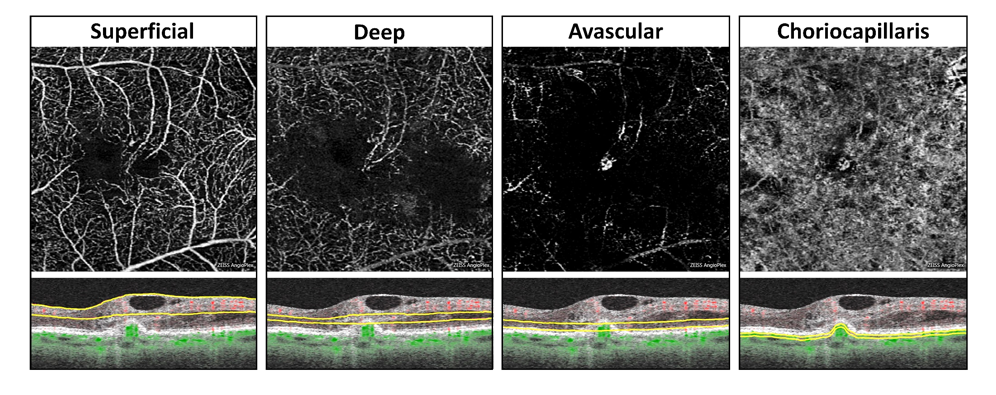 superficial and deep displays abnormal vascular choroidal neovascularization