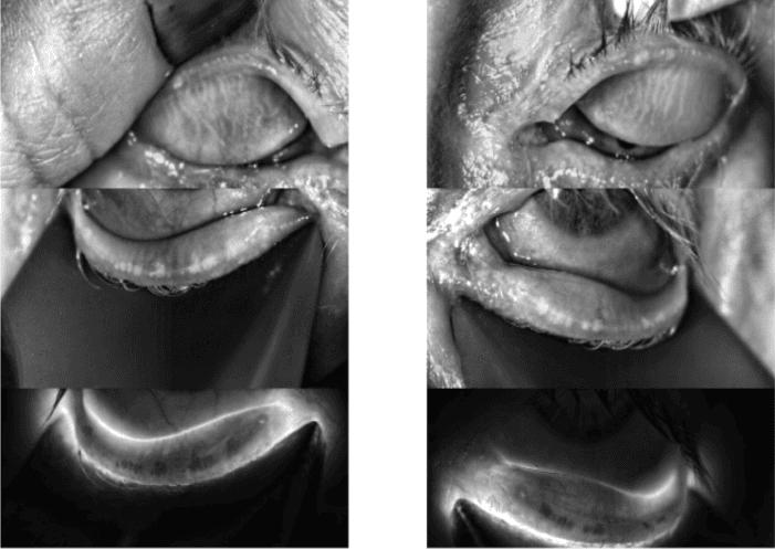 Meibomian gland loss