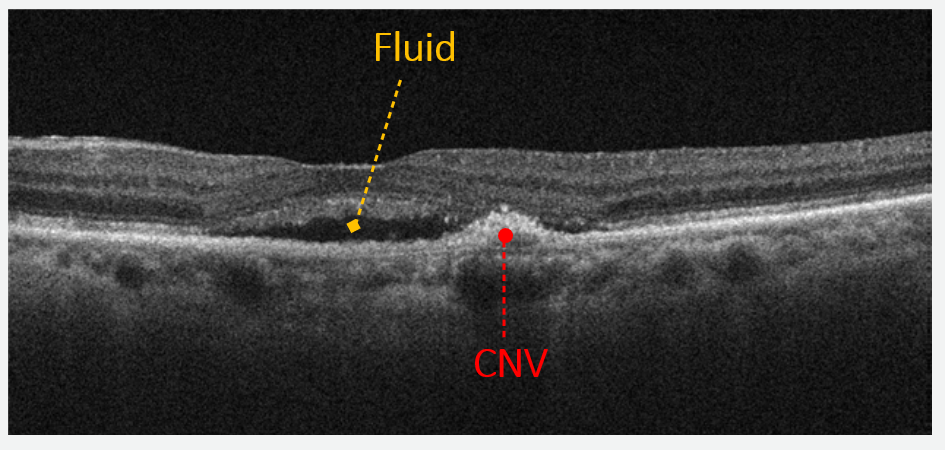 A small neovascular net can be seen with adjacent retinal edema.