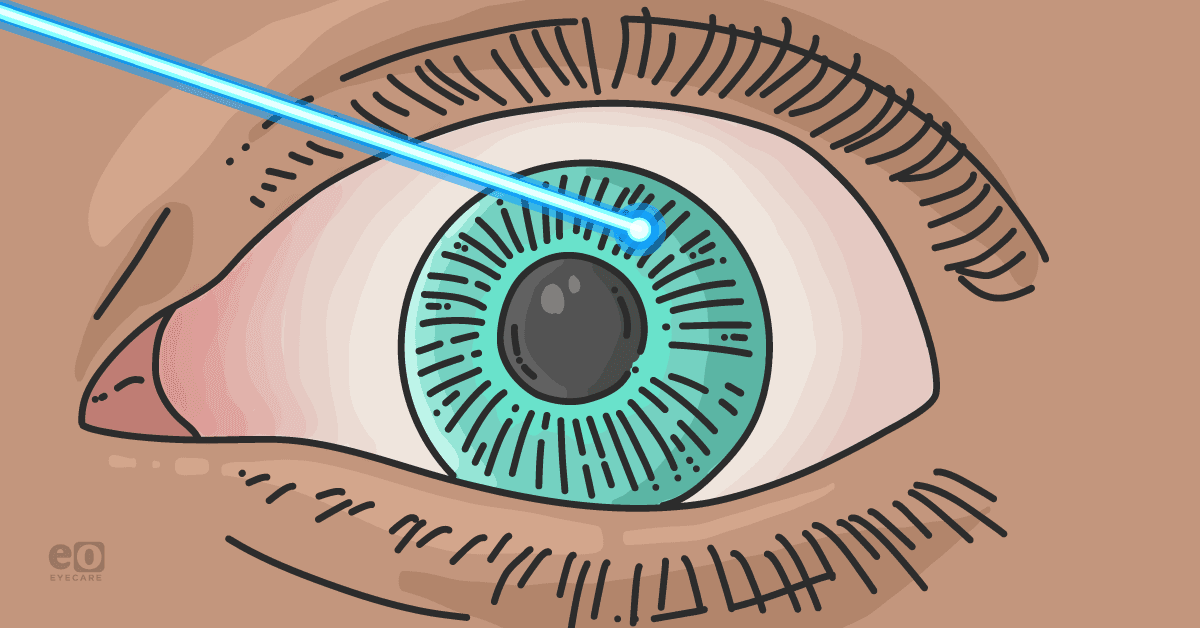 Closeup of an eye undergoing a laser peripheral iridotomy for glaucoma management.