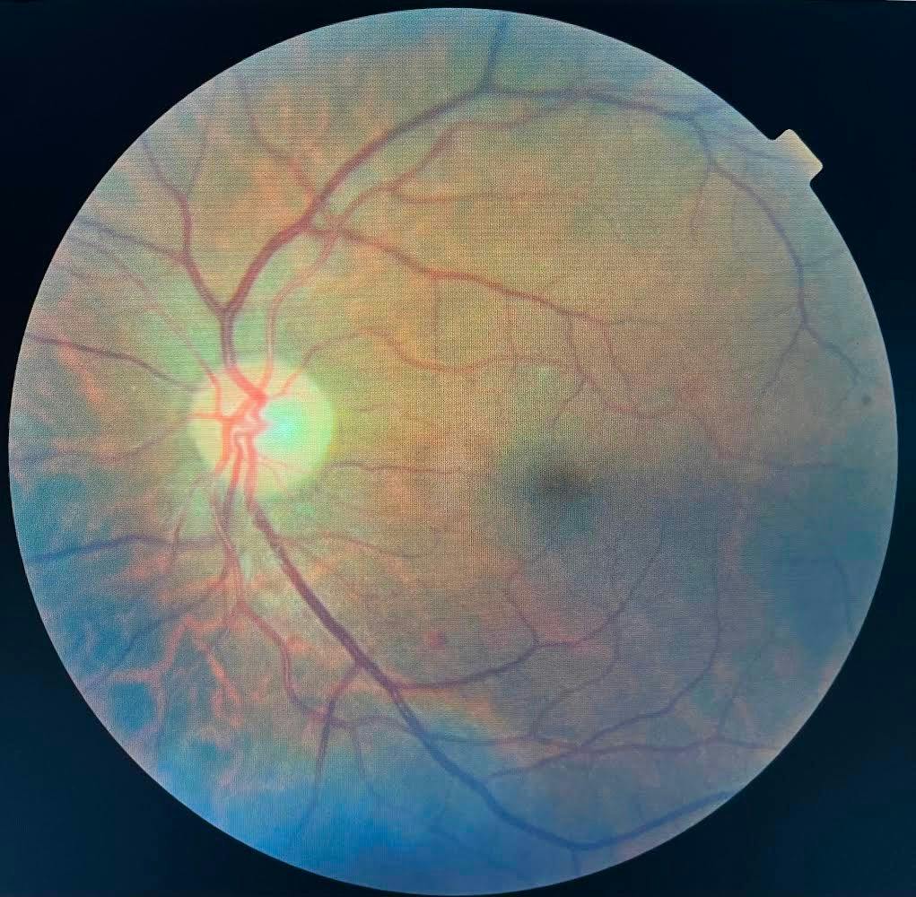 Non-proliferative diabetic retinopathy Fundus OS