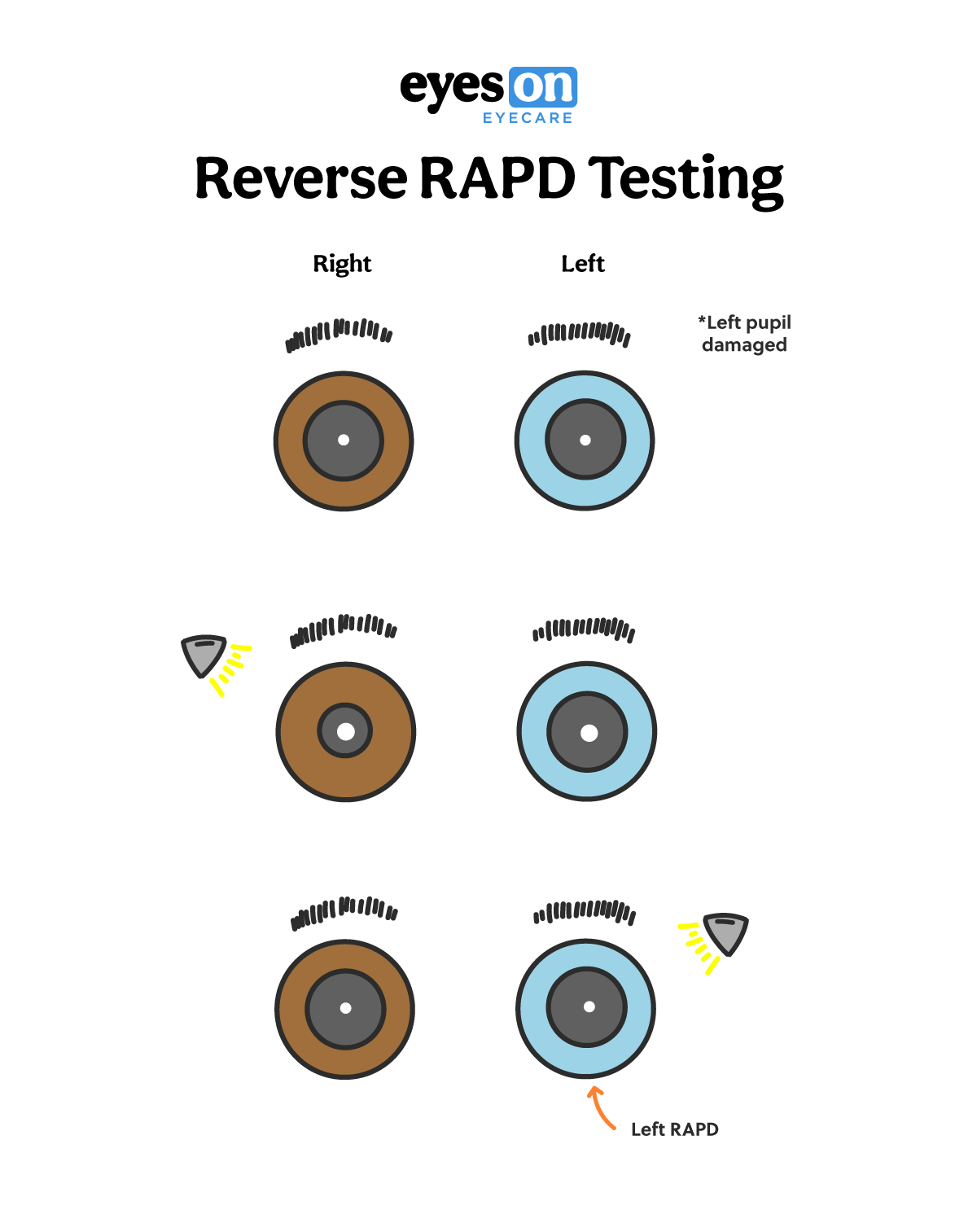 https://covalentcareers3.s3.amazonaws.com/media/original_images/Afferent-Pupillary-Defect_Cheat-Sheets_Reverse-RAPD-Testing.png