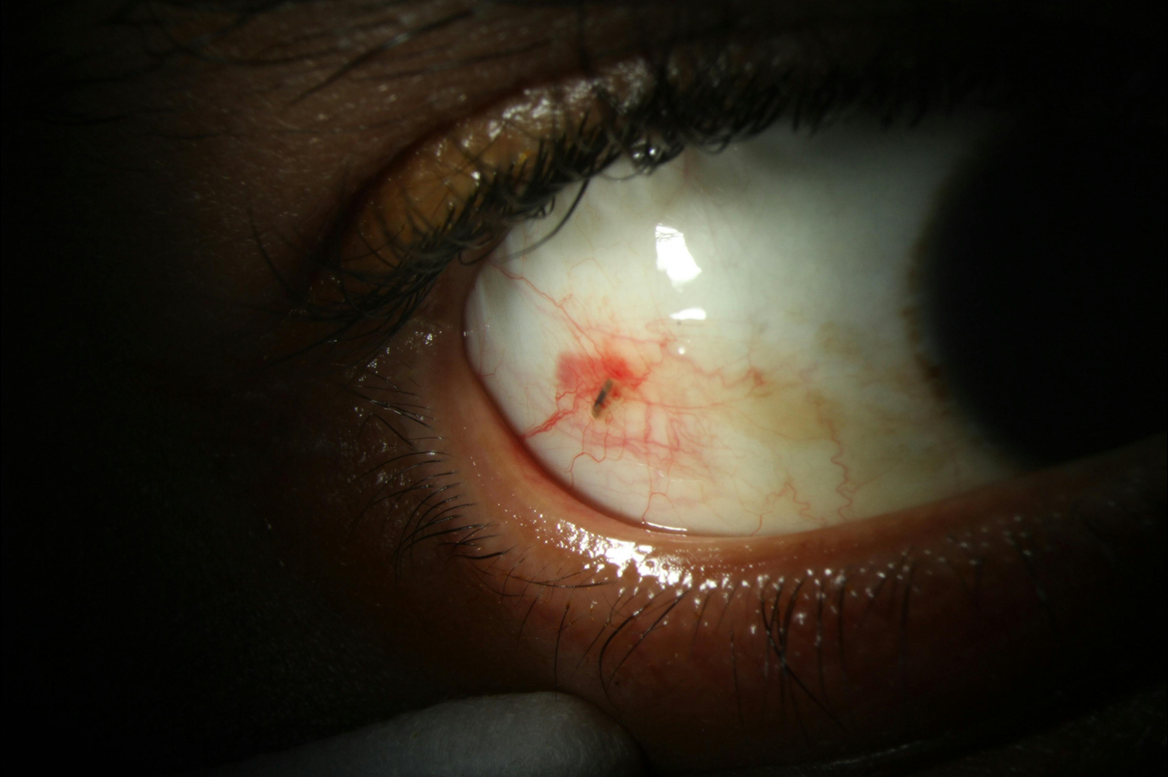 https://covalentcareers3.s3.amazonaws.com/media/original_images/Conjunctival_Foreign_Body_Article.jpg