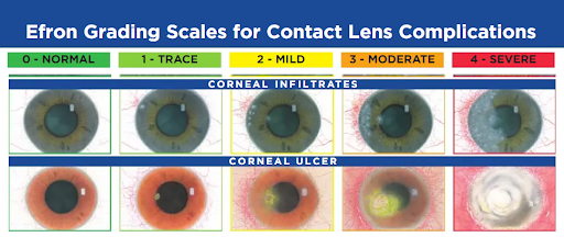 https://covalentcareers3.s3.amazonaws.com/media/original_images/Efron-grrading-scale-for-contact-lenses.png