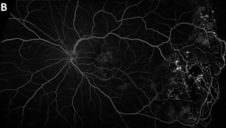 https://covalentcareers3.s3.amazonaws.com/media/original_images/Exudative_retinopathy_1B.png