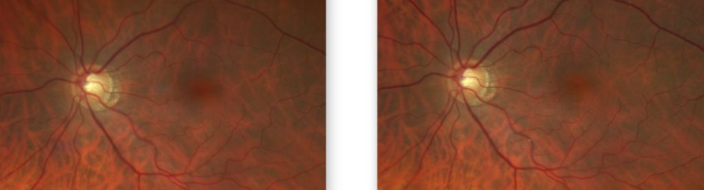 https://covalentcareers3.s3.amazonaws.com/media/original_images/Glaucoma-Retinal-Image-3-1024x277.png