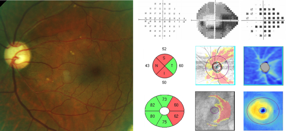 https://covalentcareers3.s3.amazonaws.com/media/original_images/Glaucomatous-Field-Loss-with-RNFL-and-GCA-Analysis.png
