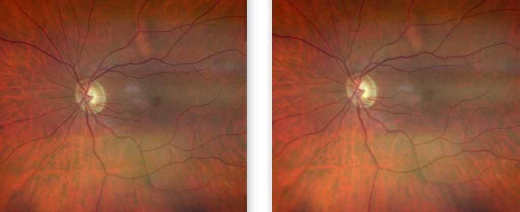 https://covalentcareers3.s3.amazonaws.com/media/original_images/Glaucomatous-Retinal-Image-4-1024x417.png