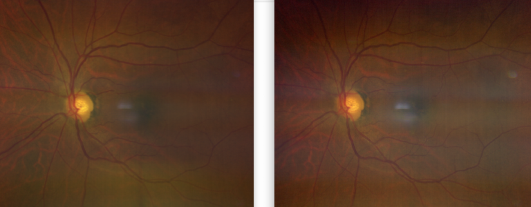 https://covalentcareers3.s3.amazonaws.com/media/original_images/Glaucomatous-Retinal-Image-5-768x300.png