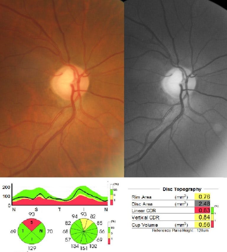 https://covalentcareers3.s3.amazonaws.com/media/original_images/Primary-open-angle-glaucoma-768x852.jpg