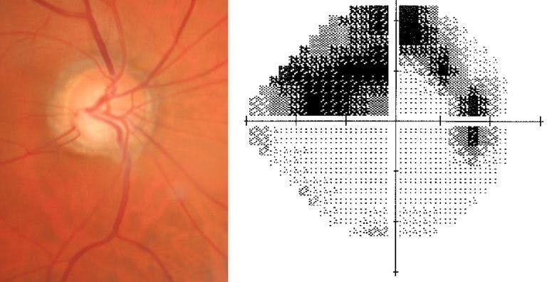 https://covalentcareers3.s3.amazonaws.com/media/original_images/Primary-open-angle-glaucoma-right-eye-768x397.jpg