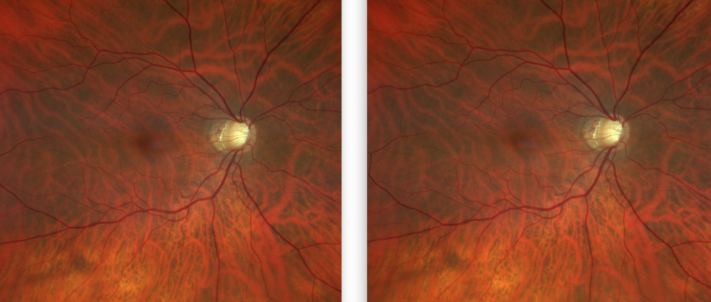 https://covalentcareers3.s3.amazonaws.com/media/original_images/Retinal-Image-Glaucoma-2-1024x435.png