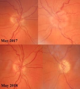 https://covalentcareers3.s3.amazonaws.com/media/original_images/Secondary-optic-atrophy-in-optic-neuritis-270x300.jpg