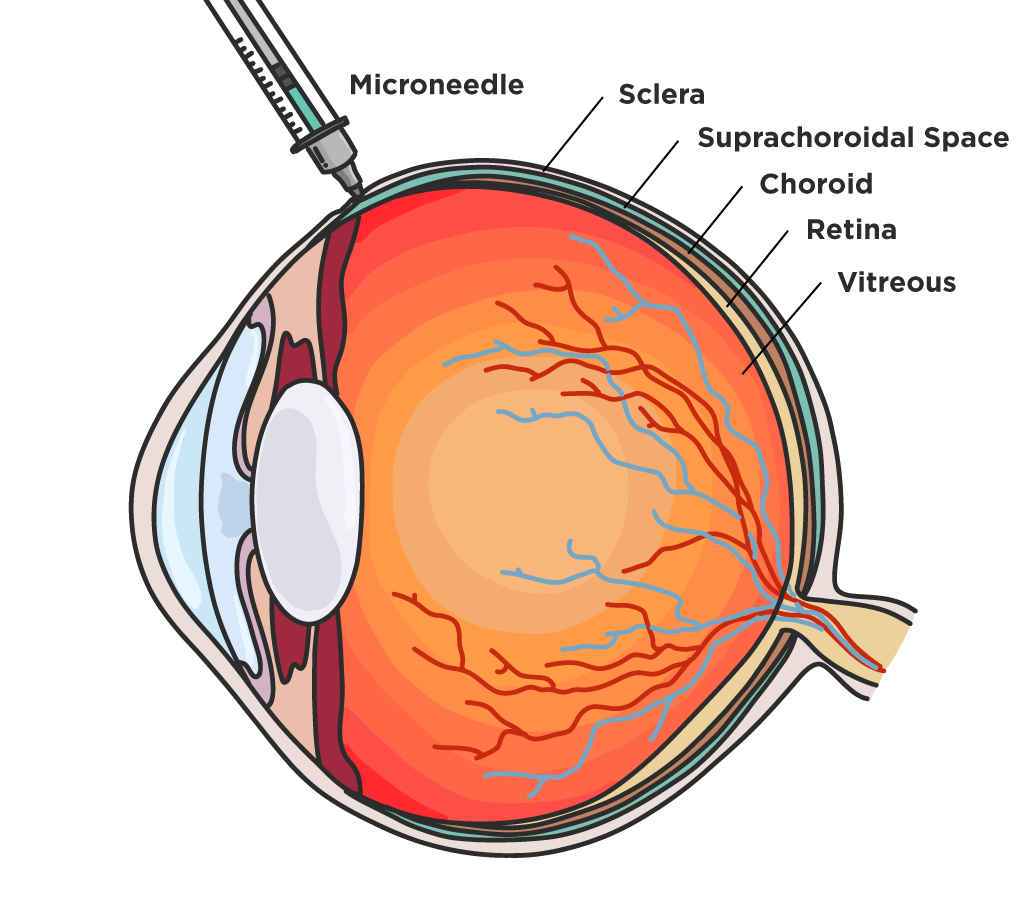 https://covalentcareers3.s3.amazonaws.com/media/original_images/The-Ophthalmology-Residents-Guide-to-Suprachoroidal-Therapy_In-Read-Image_.png