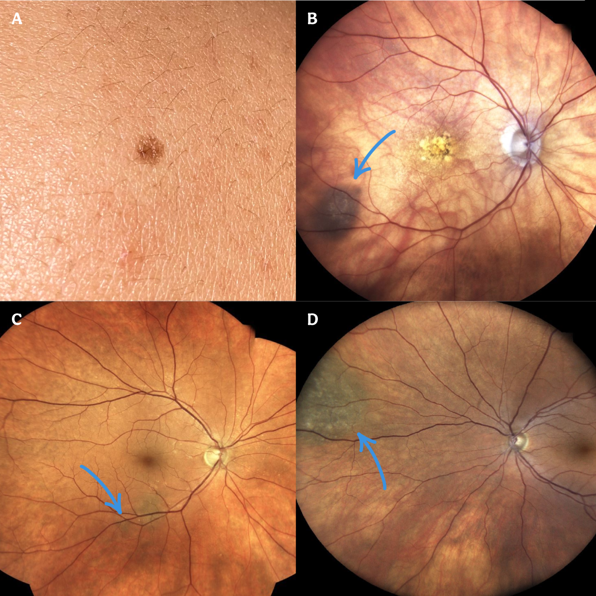 https://covalentcareers3.s3.amazonaws.com/media/original_images/The-Ultimate-Guide-to-Diagnosing-a-Choroidal-Nevus_Images_Choroidal-Nevus.png