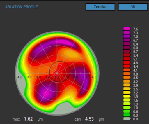 https://covalentcareers3.s3.amazonaws.com/media/original_images/Topography-only_corneal_ablation_profile.png