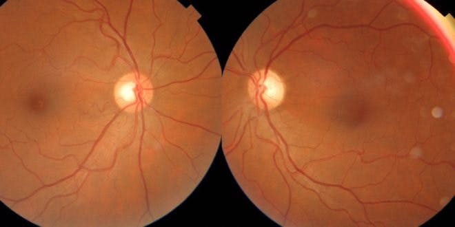 https://covalentcareers3.s3.amazonaws.com/media/original_images/Traumatic-optic-neuropathy-left-eye-660x330.jpg