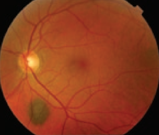 https://covalentcareers3.s3.amazonaws.com/media/original_images/Typical_Choroidal_Nevus.png