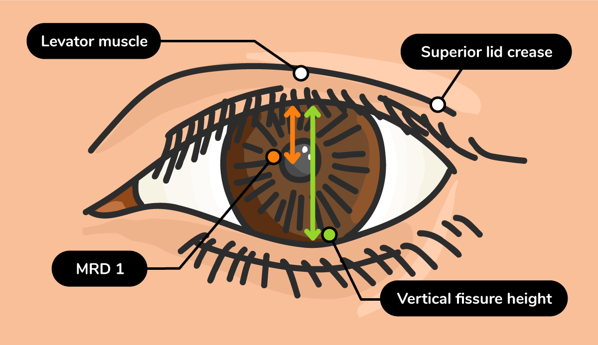 https://covalentcareers3.s3.amazonaws.com/media/original_images/Ultimate-Guide_Ptosis_In-Line-Images_Ptosis-Lid-Measurement-Illustration_1.png