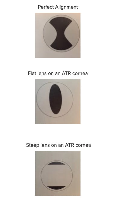 https://covalentcareers3.s3.amazonaws.com/media/original_images/against-the-rule-astigmatism-toric-lens-rgp-troubleshooting.jpg