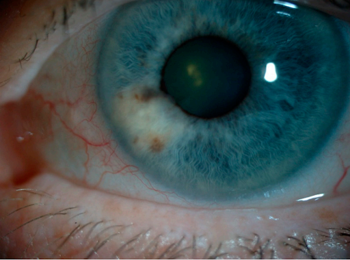 https://covalentcareers3.s3.amazonaws.com/media/original_images/amelanotic-lesion-iris.png