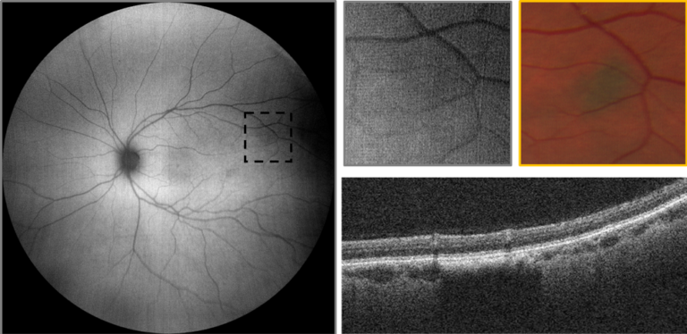 https://covalentcareers3.s3.amazonaws.com/media/original_images/clarus-500-choroidal-nevus-FAF-and-OCT-768x374.png