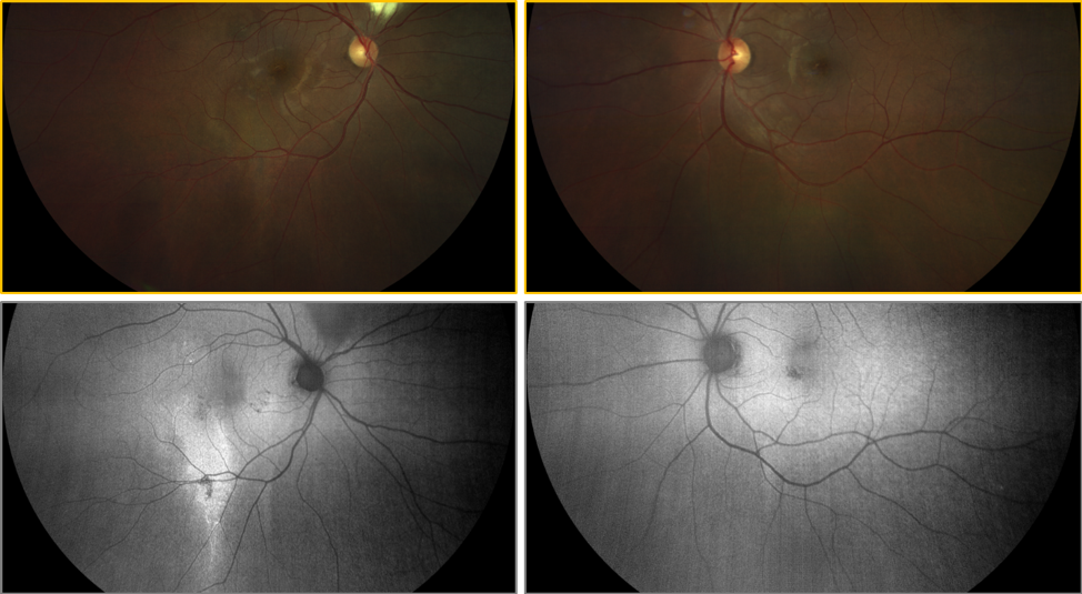 https://covalentcareers3.s3.amazonaws.com/media/original_images/clarus-500-faf-of-retinal-atrophy.png