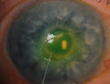 https://covalentcareers3.s3.amazonaws.com/media/original_images/corneal-abrasion-red-eye.png